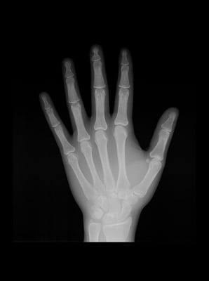 Mão e Punho(índice carpal)