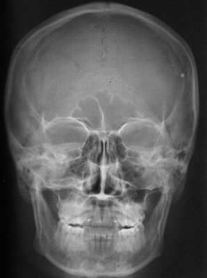 P A Mandibula (Towne)