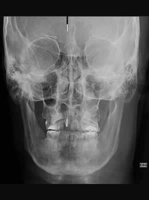 Telerradiografia frontal